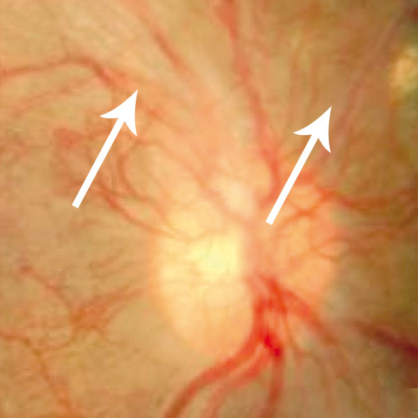 proliferative retinopathie maximilians augenklinik nuernberg